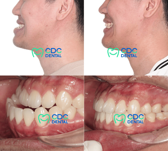เคสตัวอย่างคางยื่น ฟันล่างครอบฟันบน ก่อนและหลังผ่าตัด 2 ขากรรไกรและคาง CDC Dental