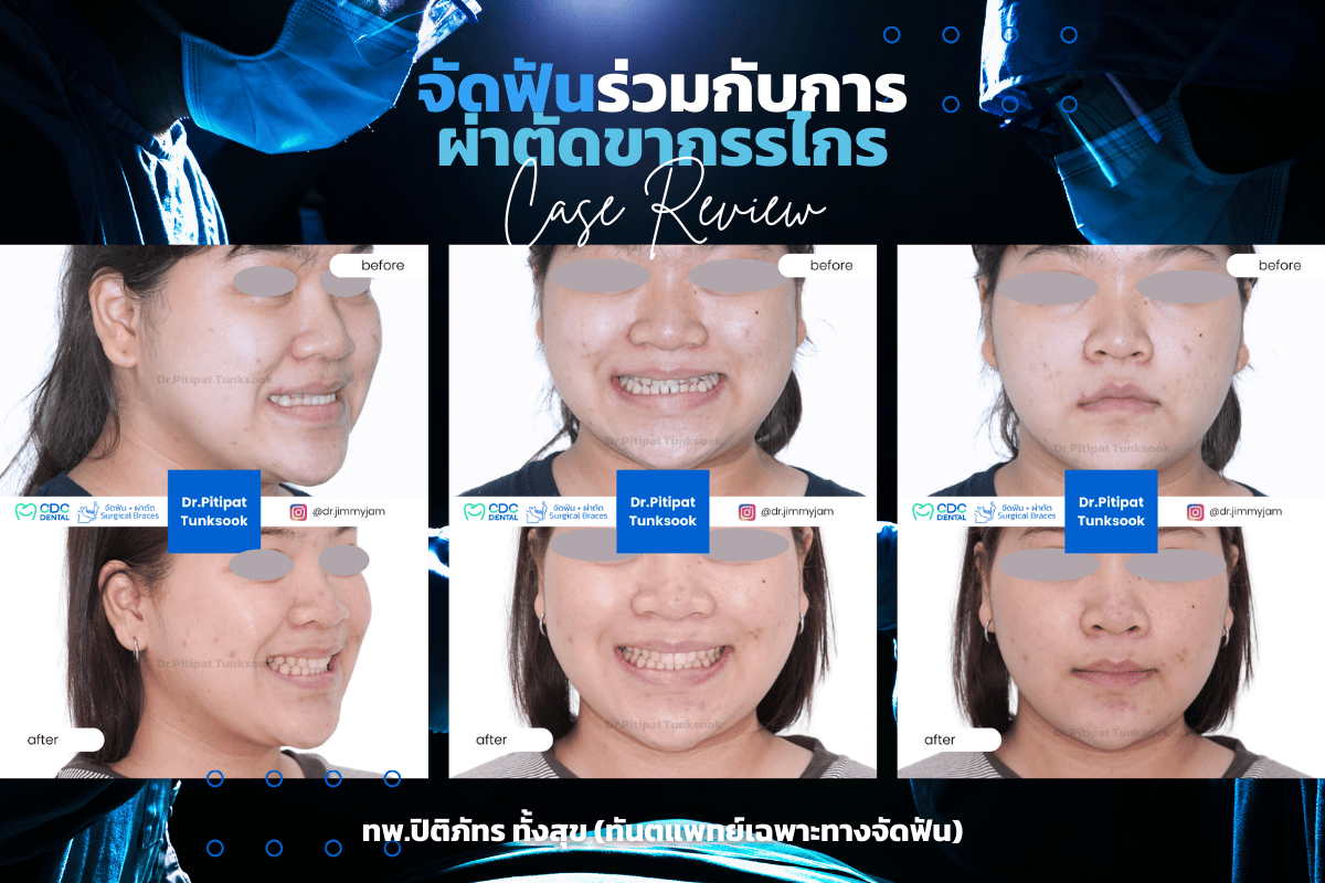 รีวิวจัดฟัน ผ่าตัด