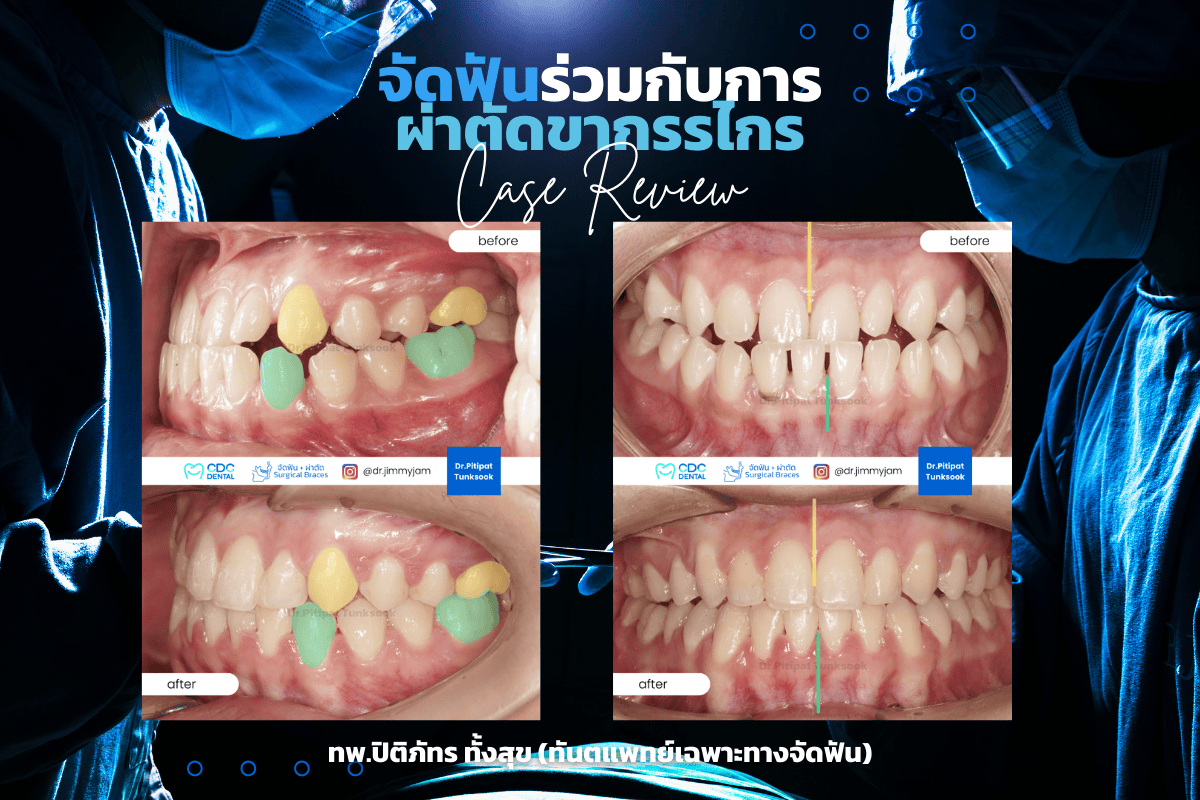 รีวิวจัดฟัน ผ่าตัด คางยื่น