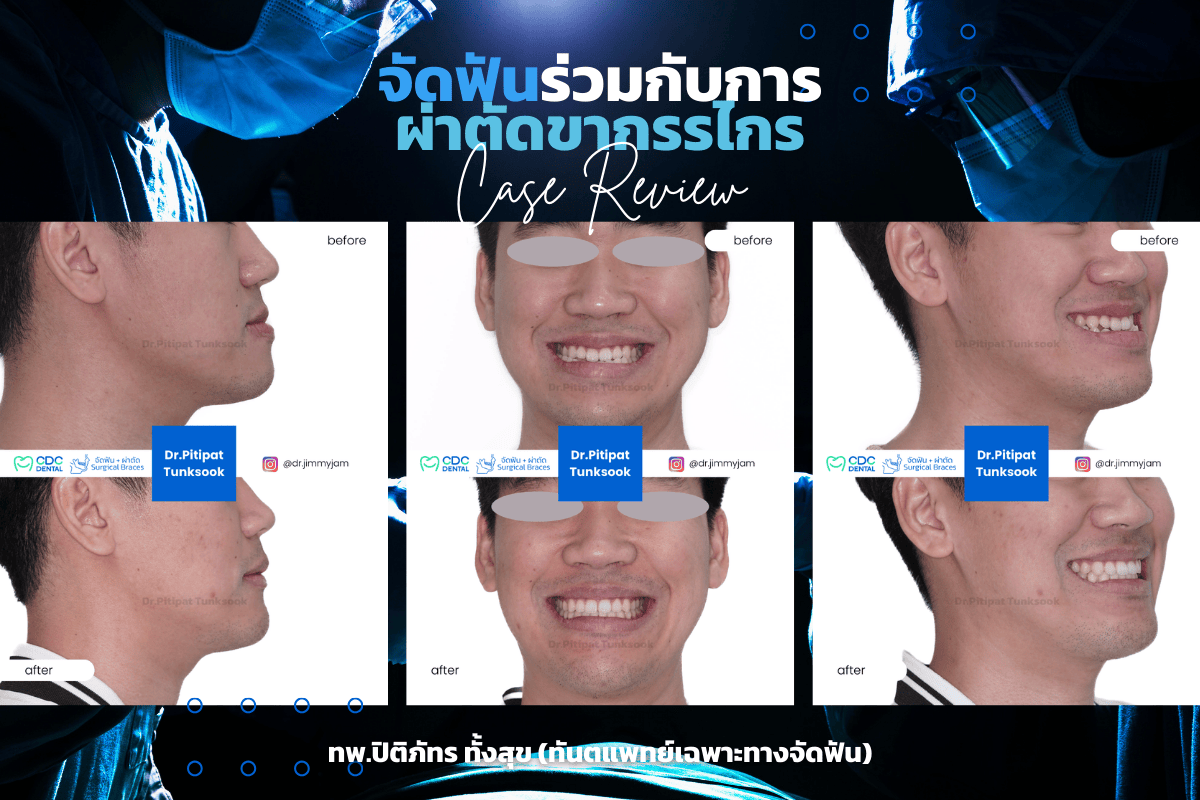 จัดฟัน ผ่าตัด รีวิว