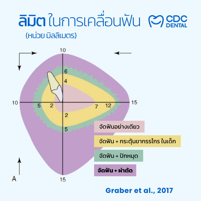 ข้อจำกัดในการจัดฟัน