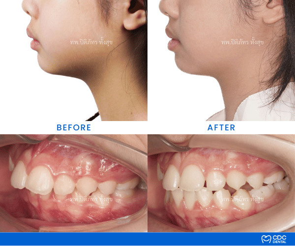 รีวิวจัดฟัน twin block