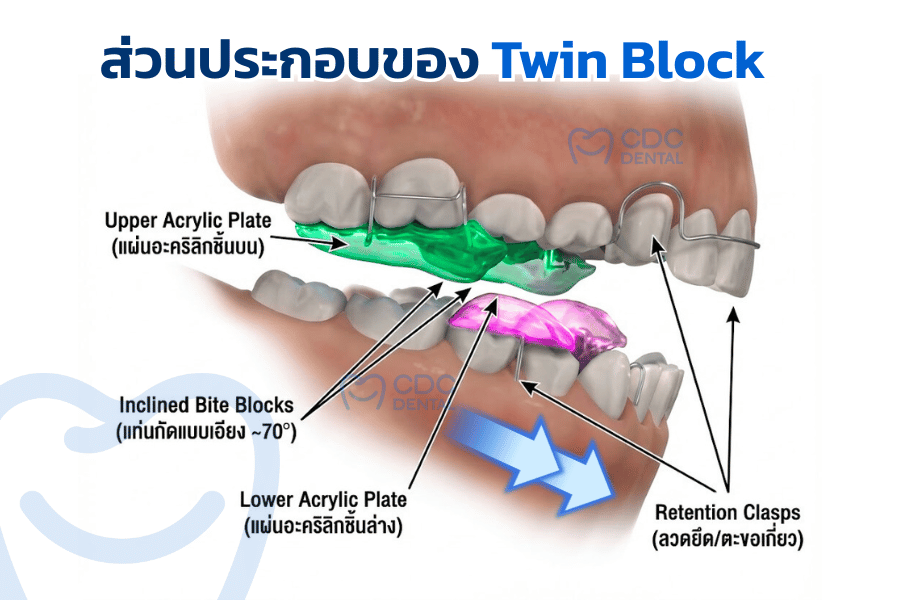 จัดฟัน twin block คือ