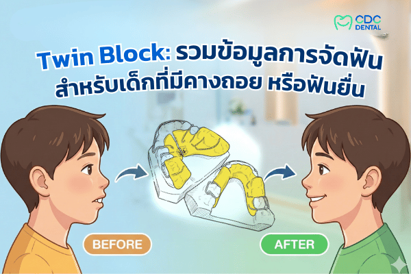 จัดฟัน twinblock