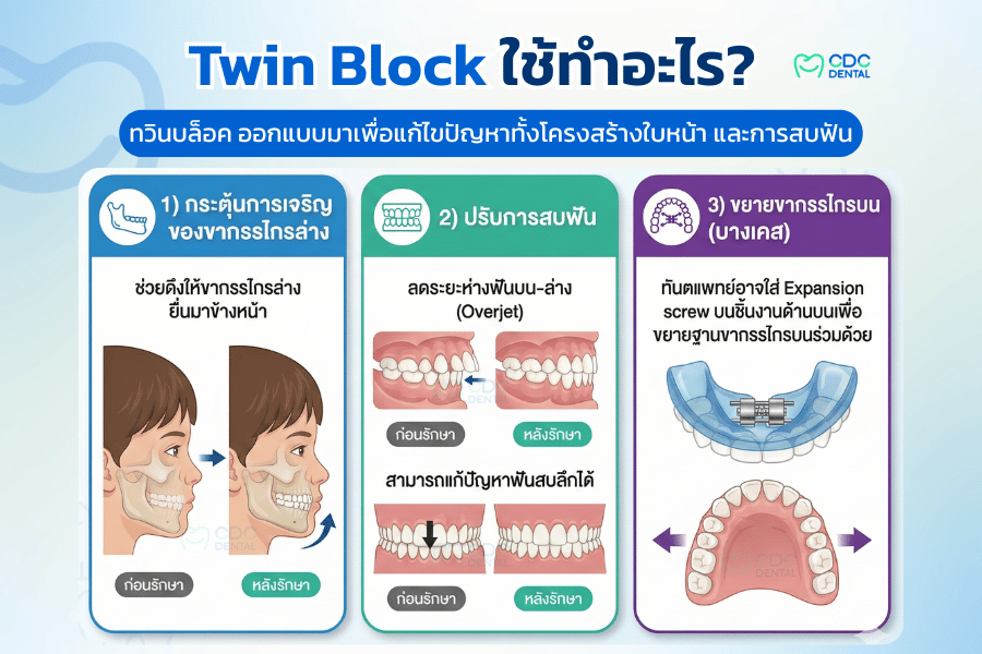 จัดฟัน twin block ใช้ทำอะไร