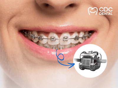 จัดฟันดาม่อน Damon System