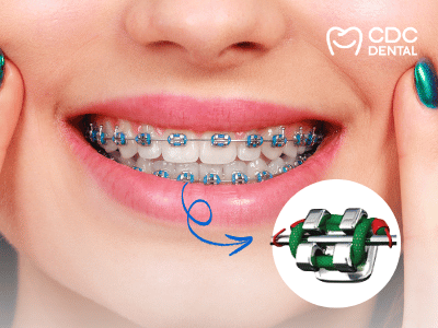 จัดฟันโลหะ Metal Braces