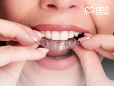 จัดฟันใส Clear Aligners