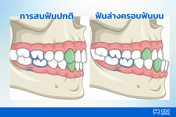 ภาพเปรียบเทียบการสบฟันปกติกับฟันล่างครอบฟันบน (Underbite) ในเด็ก